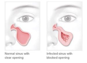 diagram with normal sinus vs infected sinus